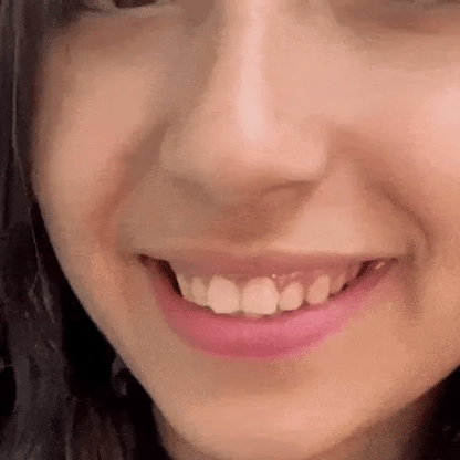Herline SmileForm Profil Diş Estetik Seti ( Alt Üst Set )