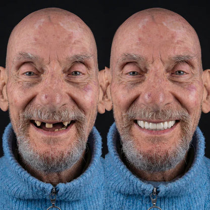 Herline SmileForm Profil Diş Estetik Seti ( Alt Üst Set )