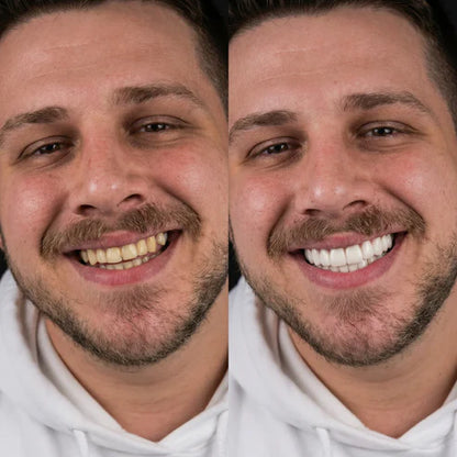 Herline SmileForm Profil Diş Estetik Seti ( Alt Üst Set )